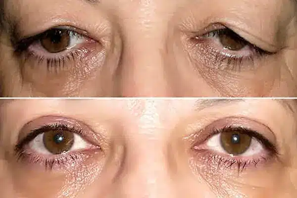 blefaroplastia