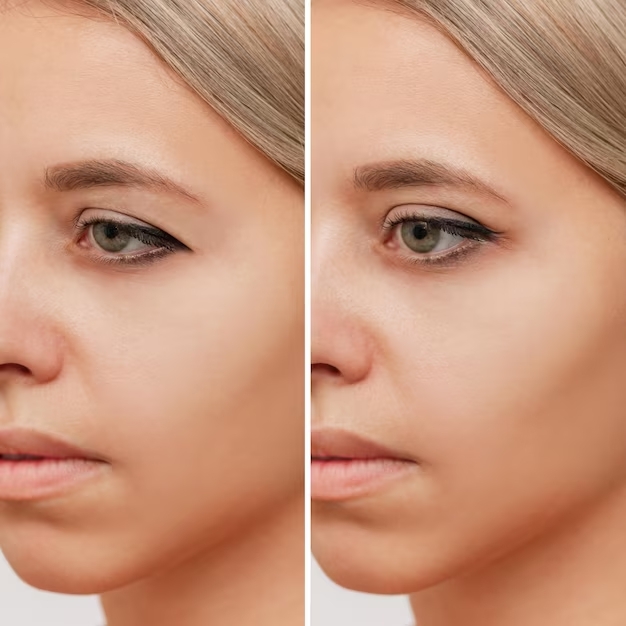 Blefaroplastia