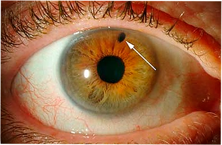 Iridotomia a Laser